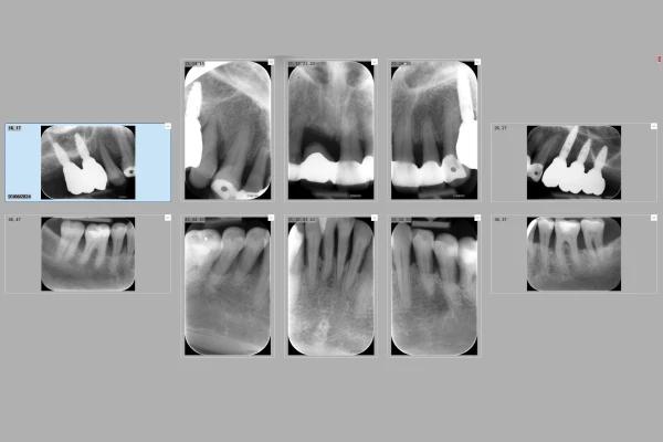 Technologies du cabinet B des Drs Bezzina, Biens, Stefan & Sabot à Nice : bilan rétro-alvéolaire numérique